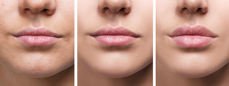 LipFillersBeforeAndAfter