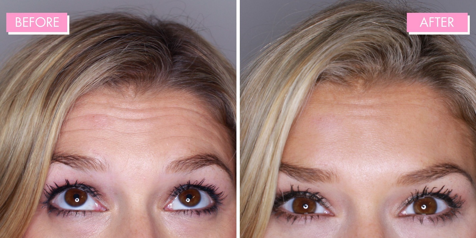 Forehead line reduction with preventative Botox